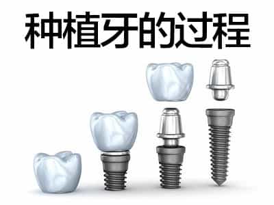 天津全口种植牙分几个阶段 如何治疗还是首选中诺