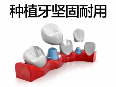天津种植牙半口有几种方法 品质首选中诺口腔好