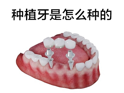 天津皓圣半口种植牙要多长时间 种植牙是怎么种的
