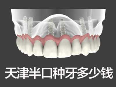 安全高效率质量种植-天津半口牙种植多少钱