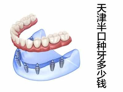 天津登腾种牙半口需要多少钱，受什么因素影响