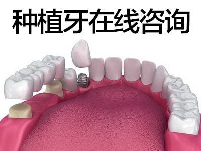 普及稳定安全种植 天津种植牙分几种牙
