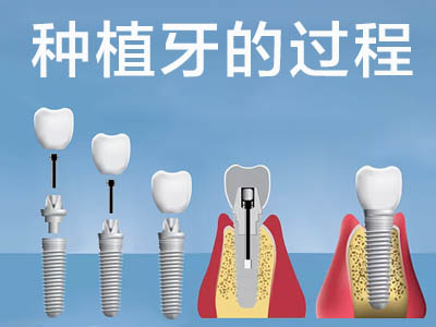 天津hiossen全口种植牙的过程步骤 种植牙的几个步骤