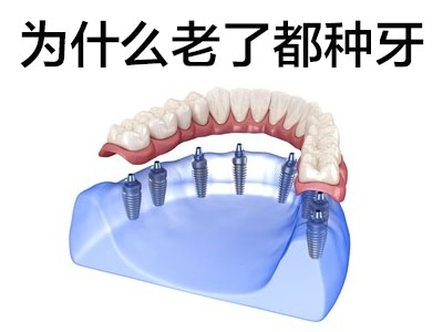 天津满口种植牙需要几个桩-ALL-on-4-6种植牙技术