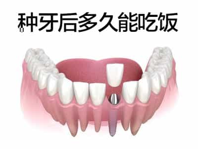 天津OSSTEM种牙后多久可以吃饭，种植牙后恢复