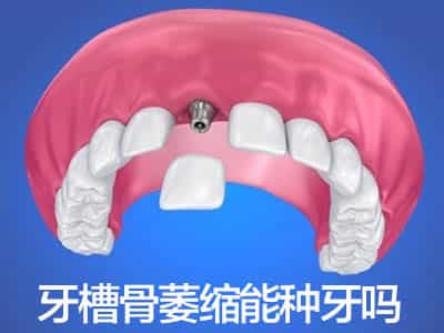 牙龈萎缩用管吗？天津牙龈萎缩还能种牙吗