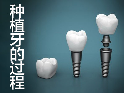 天津种植牙二期手术后多久可以装牙