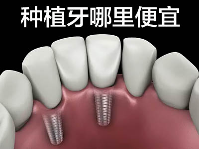 天津瑞典astra满口种植牙价目表