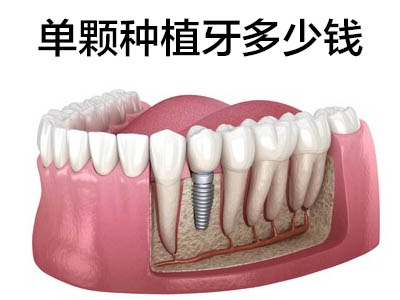 解答天津德国费亚丹半口全口种植牙需要多少钱