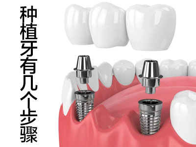 天津安装种植牙的过程需要多久