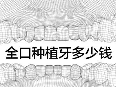 植一颗牙大概多少钱？天津法国安卓健全口种植牙价目表