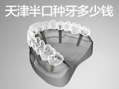 天津整口种植牙口腔医院一共多少钱-种植牙价格表