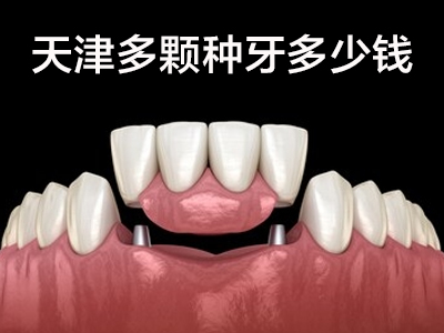 天津美国百康全口种植牙一共多少钱