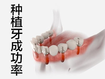 什么是种植导板？天津数字化种植牙是什么意思?