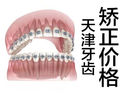 天津口腔医院牙齿矫正价格表-牙齿矫正多少钱