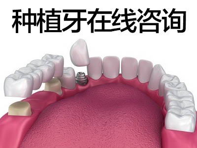 天津法国Anthgoyr满口种植牙哪家好