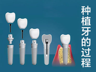 种植牙手术的详细过程   天津种牙手术需要多长时间?