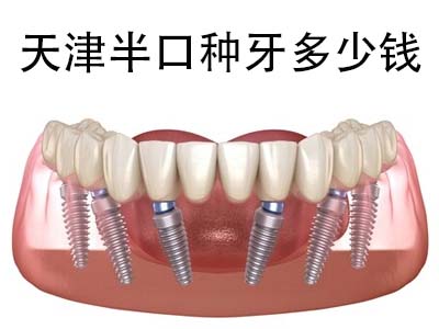 天津武清种植牙品牌及价格表