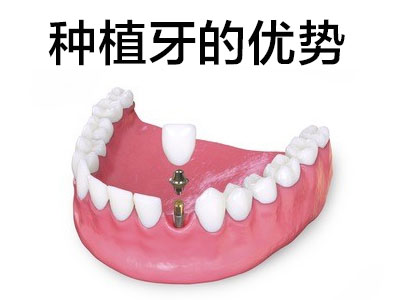 天津武清种植牙品牌及价格表