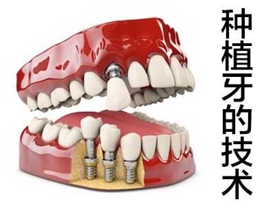 天津zui新的全口半口种植牙技术