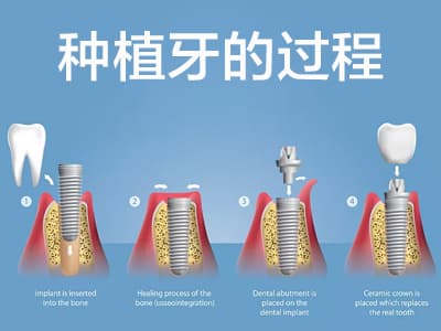 天津半口种植牙过程一般几个步骤？