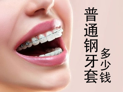 天津和平区矫正牙齿大概要多少钱-牙齿矫正价格表