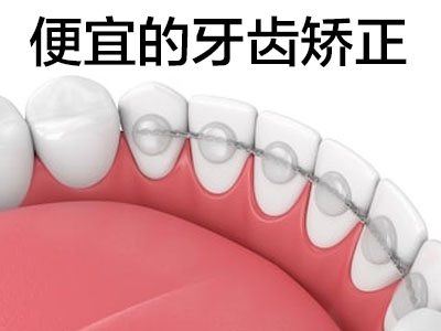 天津和平区矫正门牙一般需要多少钱-牙齿矫正价格表