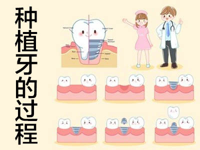 天津半口种植牙图片牙齿图片-全口种植牙种几颗？
