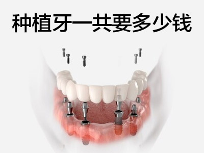 天津市面上半口种植牙一颗多少钱-种植牙价格表