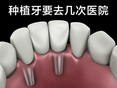 天津北辰纯钛种植牙价格表-2022种植牙价目表