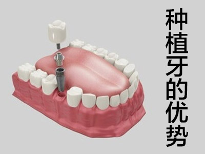 种植牙的品牌与价格 天津种植牙3000元靠谱吗?