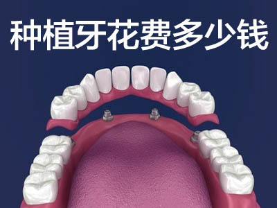 种植半口牙的效果图  天津半口牙种植大约多少钱?