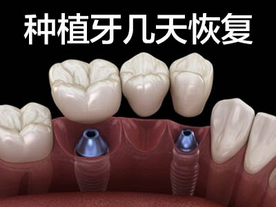 all-on-4 种植牙技术  天津all on 4全口种植牙图片