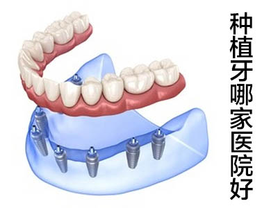 天津全口牙缺失种植8个牙根