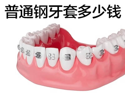 天津牙齿矫正戴隐形牙套一共需要多少钱-牙齿矫正价格表
