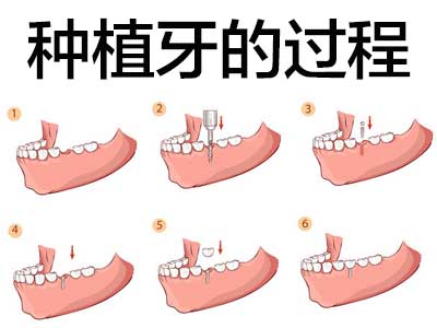 天津半口牙种植牙齿的流程和时间