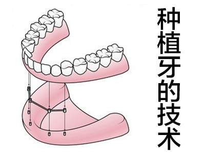 半口种植牙图 天津半口种植牙分段修复和整体修复区别?
