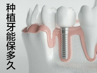 天津全口牙缺失二十年能种植牙