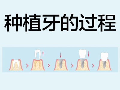 天津半口种植牙一般要多长时间