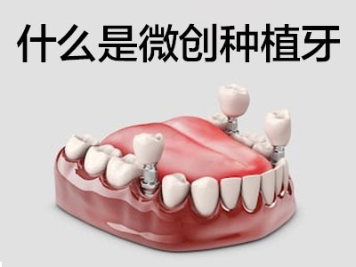 天津全口种植牙修复固定数字化种植