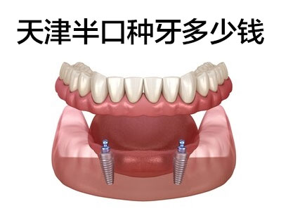 半口种植牙的费用是多少呢 安全可靠选中诺郭晓强