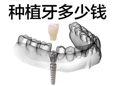 种六颗牙需要多少钱 天津老年人半口牙种植6颗植体费用?