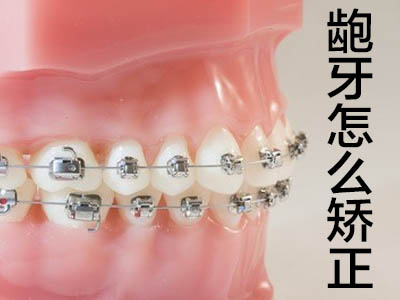 牙齿矫正的价格表 天津隐形牙套牙齿矫正一般要花多少钱一颗