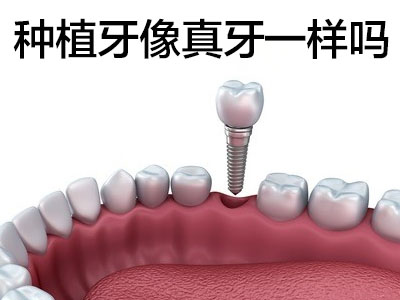 种牙多少钱一只 天津年轻人全口种植牙需要种几颗?