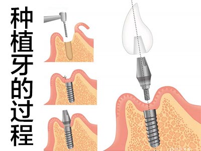 植牙的步骤 天津全口种植牙的过程步骤视频