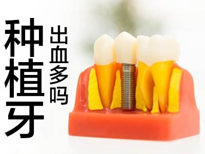 种植牙医院 半口种植牙真人图片 选用天津中诺赵振宇种植医生