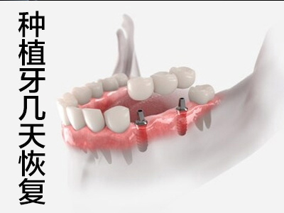 种植即刻负重修复  天津全口种植牙即刻负重视频