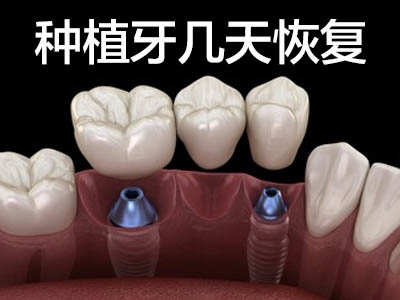 种植牙治疗周期  天津半口种植牙康复期多长时间?