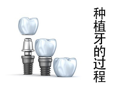 天津全口种植牙手术时间要多长时间
