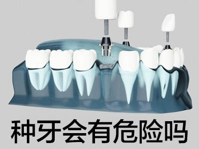种植牙价格表 天津半口种植牙一般需要多少钱